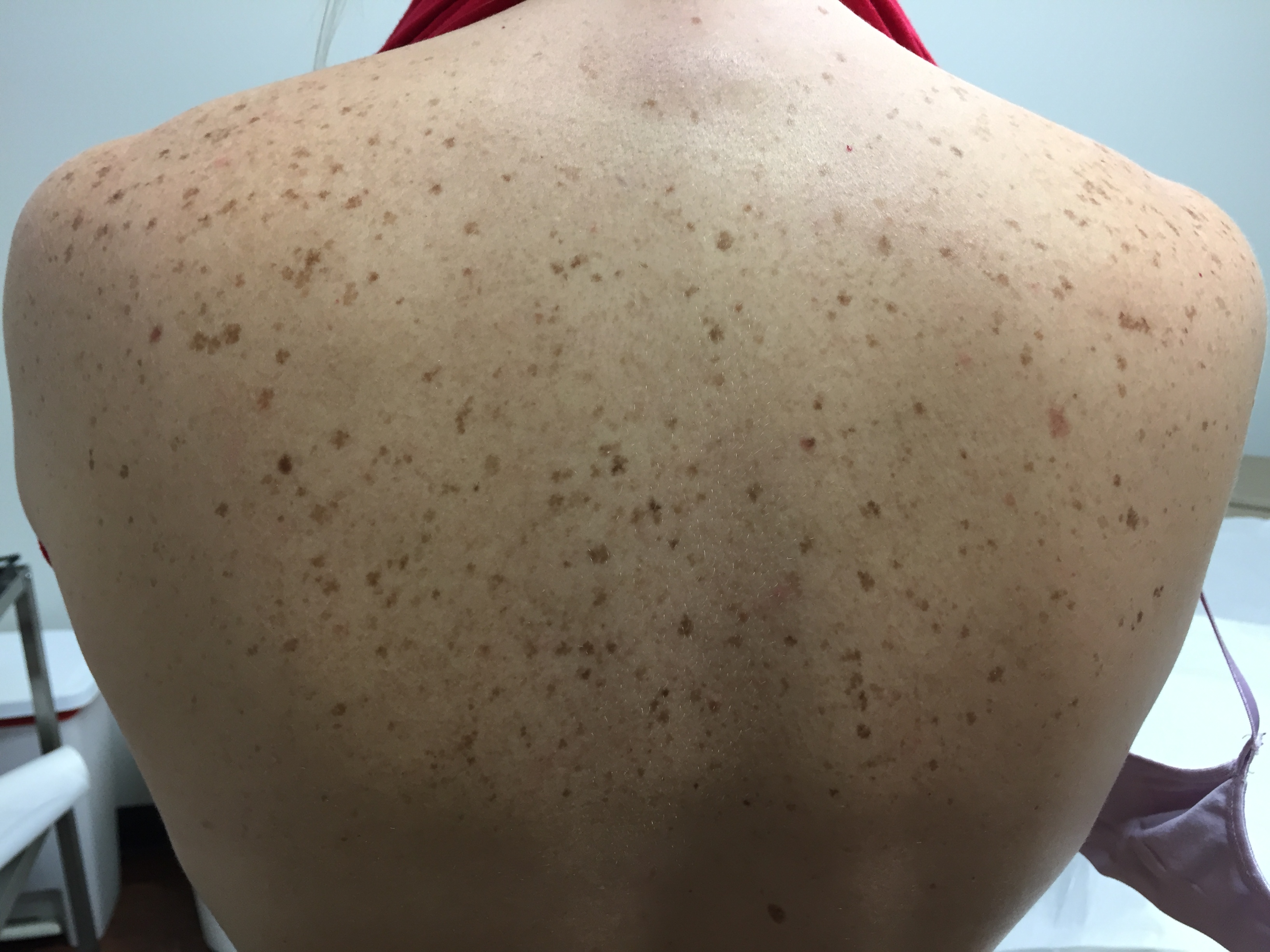 Dallas laser center treating sun spots and age spots